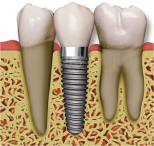 About Dental implant
